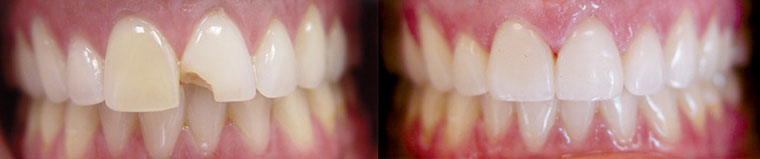 Before and After Teeth Veneers in Charlotte, NC