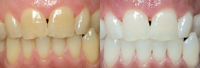 Before and After Professional Teeth Whitening in Charlotte, NC