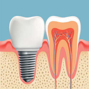 Dental implants