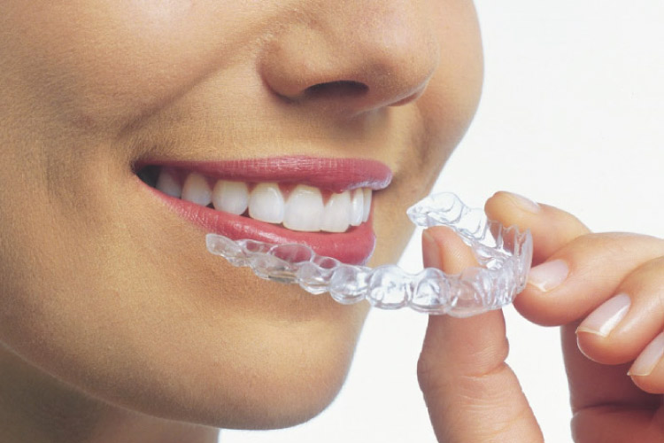 Invisalign teeth straightening