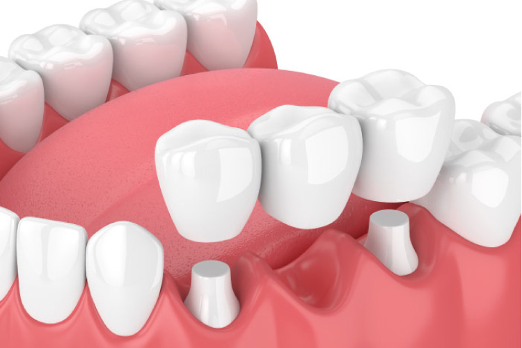 model of dental implants with a bridge