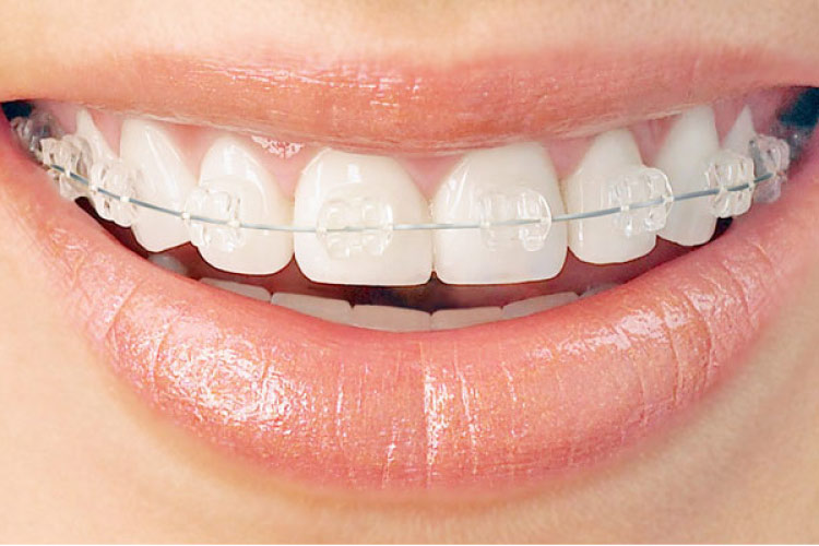 Options for Adult Invisible Braces - Carolina Smiles Family Dental