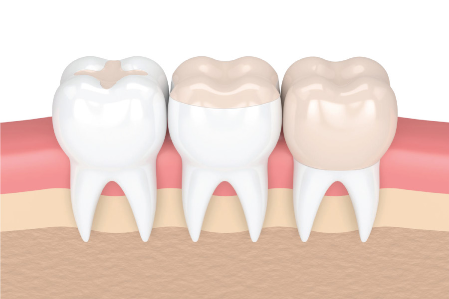 dental fillings illustration